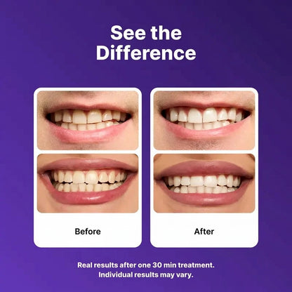 Purple Teeth Whitening Strips - 7/21 Whitening Sessions - Non Sensitive Teeth Whitening - Peroxide-Free